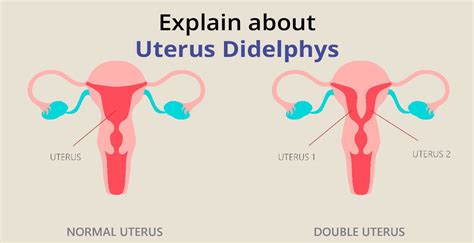 Uterus didelphys